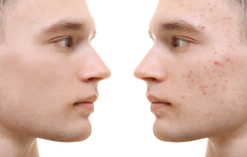 face scars from acne