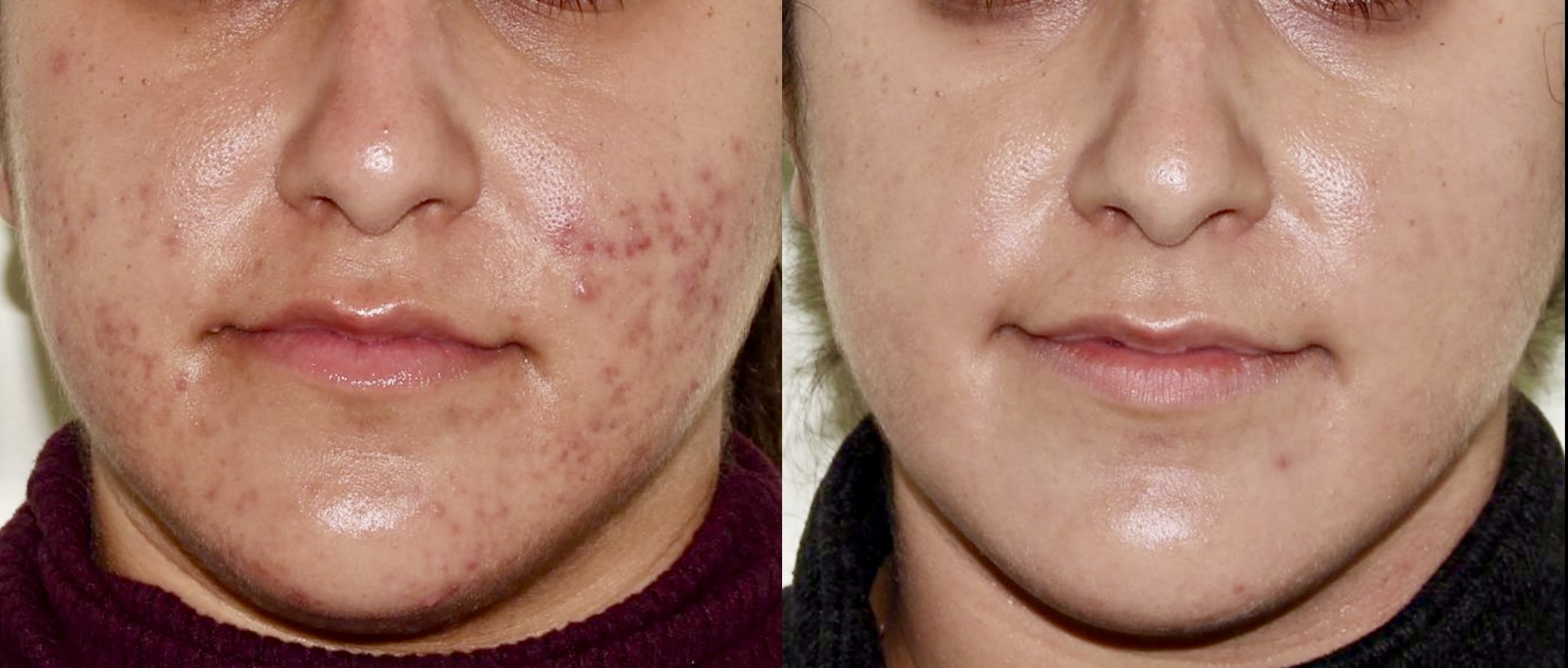 Medical Skincare + BBL – Patient Case #54 Combined Image