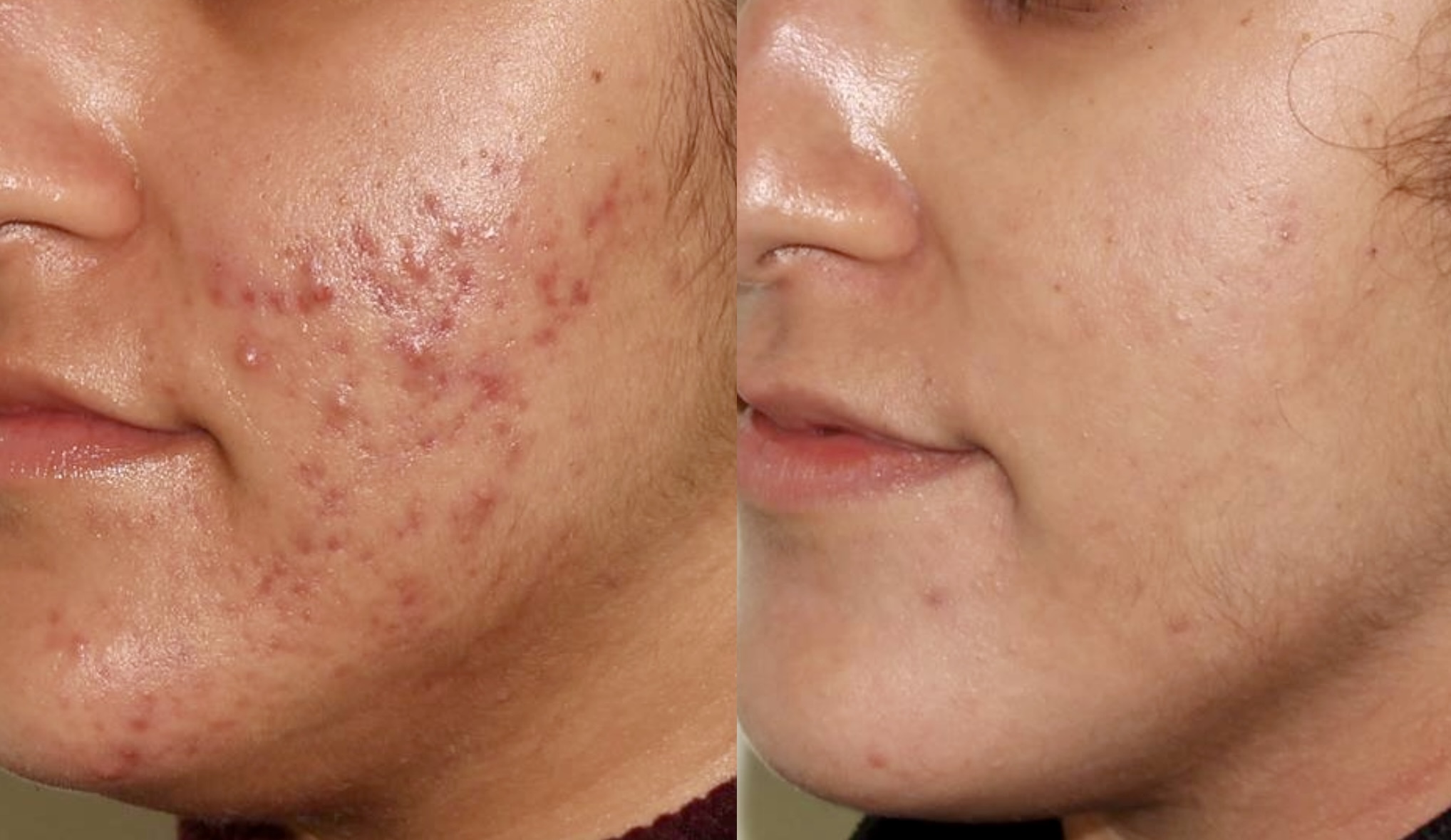 Medical Skincare + BBL – Patient Case #54 Combined Image