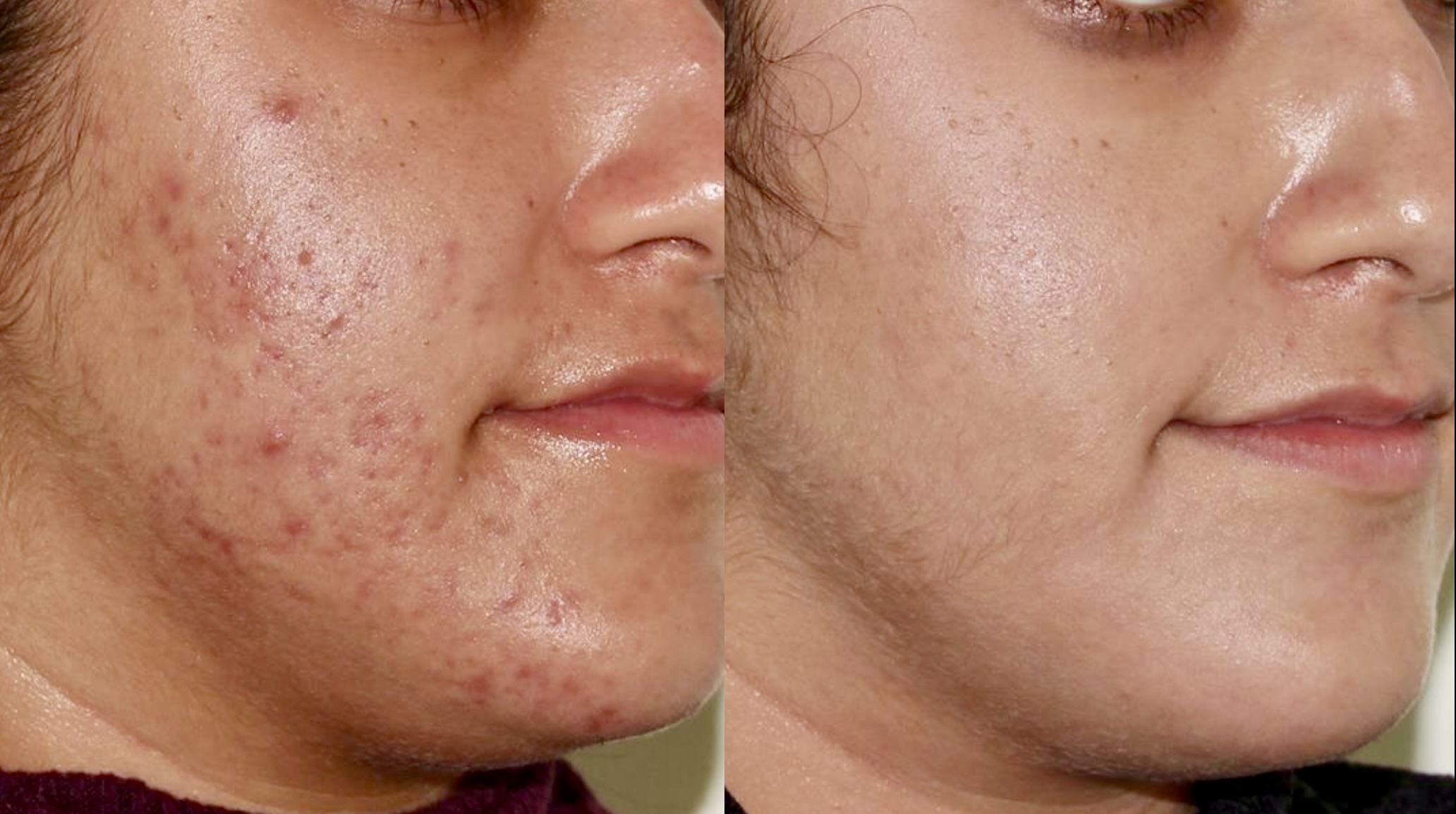 Medical Skincare + BBL – Patient Case #54 Combined Image