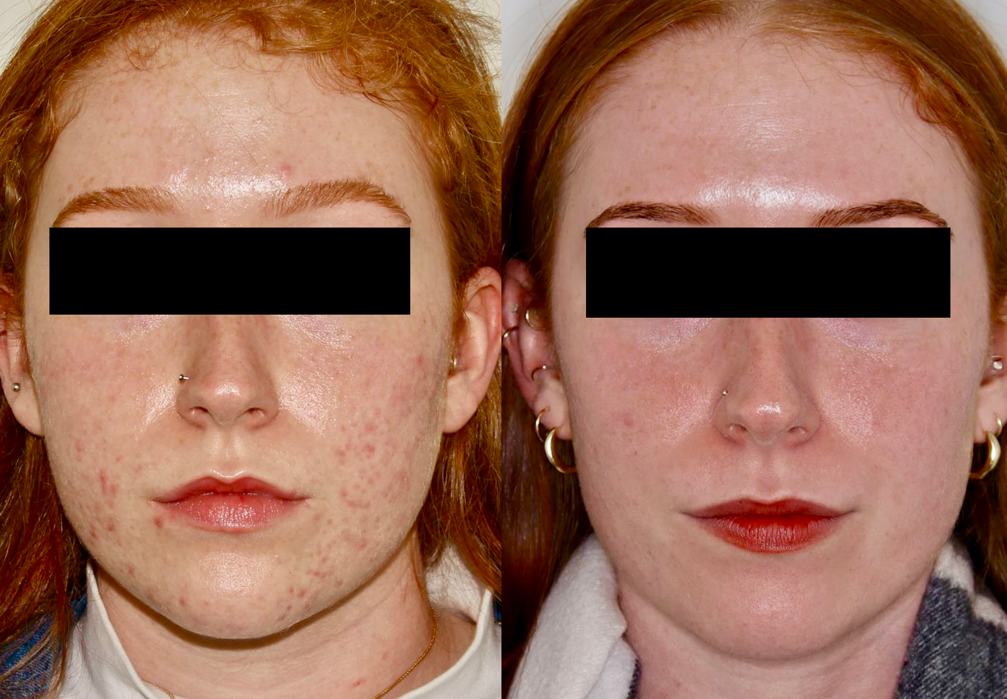 Medical Skincare + BBL – Patient Case #68 Combined Image