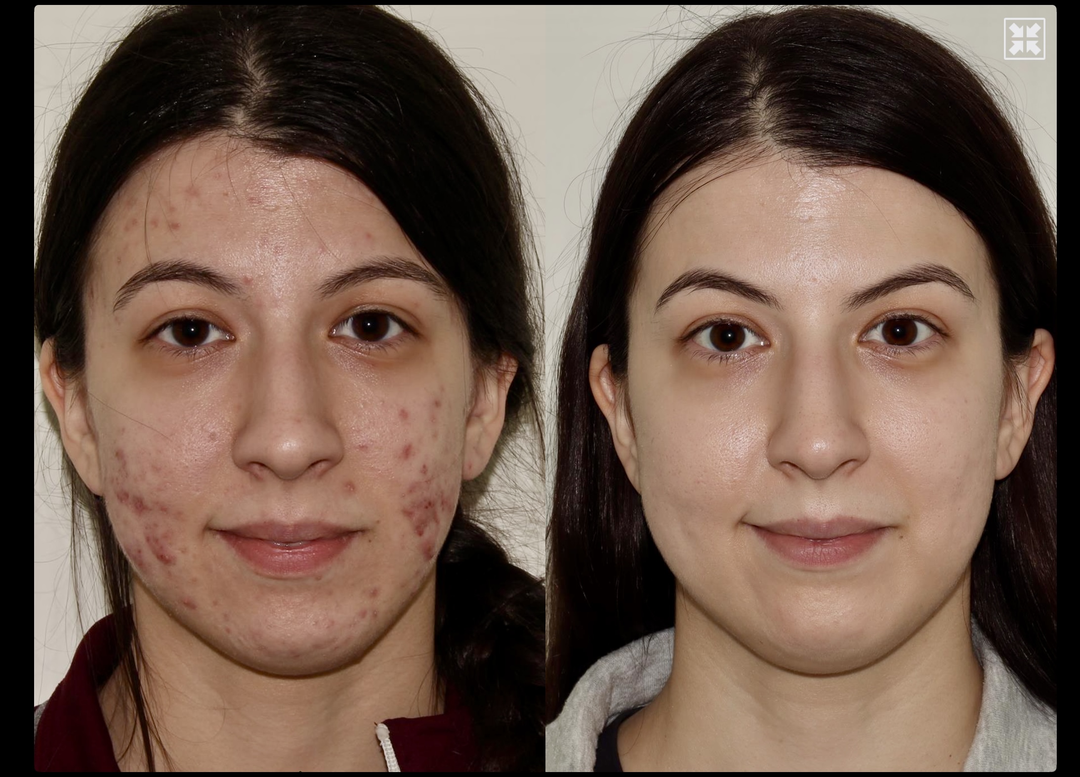 Medical Acne Treatment + BBL + Contour TRL – Patient Case #73 Combined Image