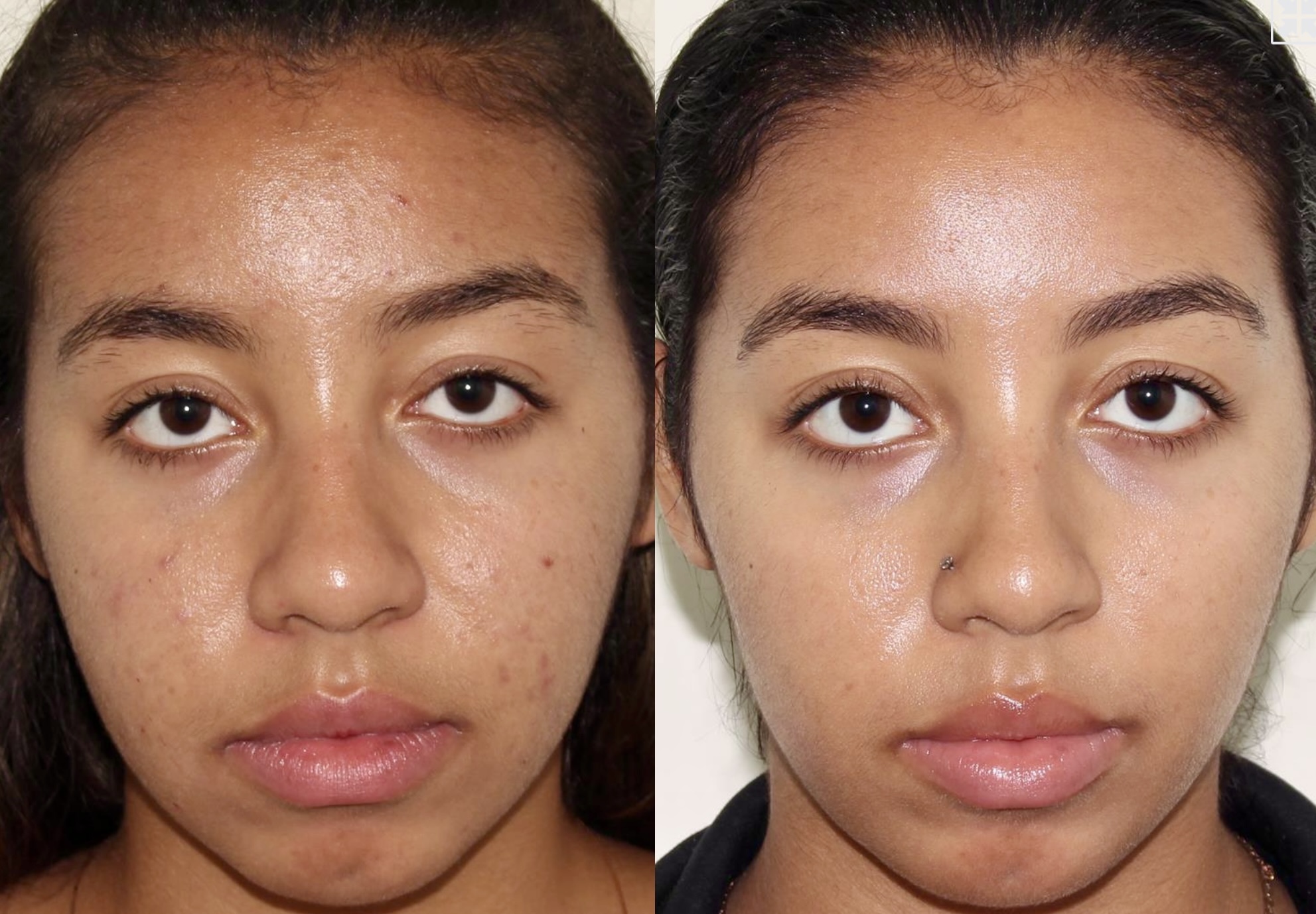 Medical Skincare + Vitalize Peel + DiamondGlow – Patient Case #79 Combined Image