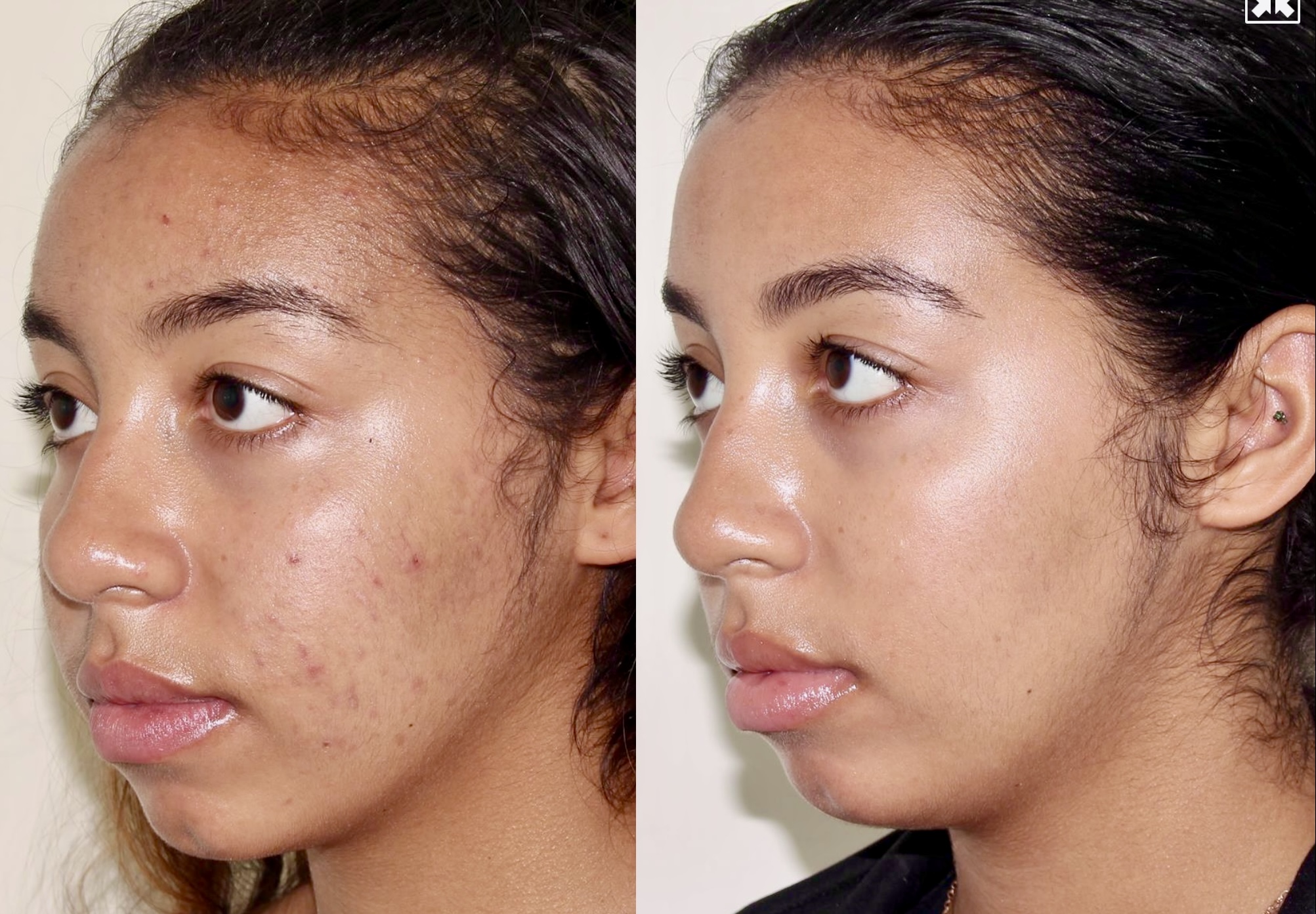 Medical Skincare + Vitalize Peel + DiamondGlow – Patient Case #79 Combined Image