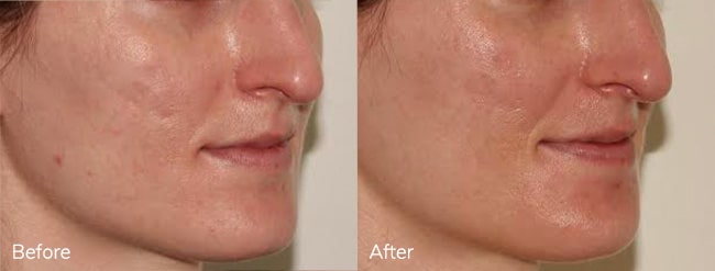 BBL + Microneedling – Patient Case #60 Combined Image