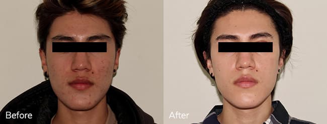 Skincare Treatment – Patient Case #59 Combined Image