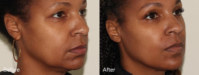 Juvederm Voluma – Patient Case #57 Combined Image