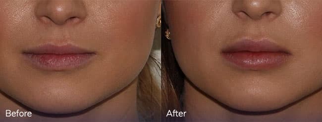 Dermal Filler Treatment – Patient Case #20 Combined Image