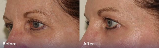 Phenol Peel Treatment – Patient Case 42 Combined Image