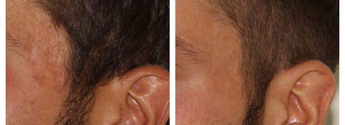 Acne Scarring Treatment – Patient Case #28 Combined Image