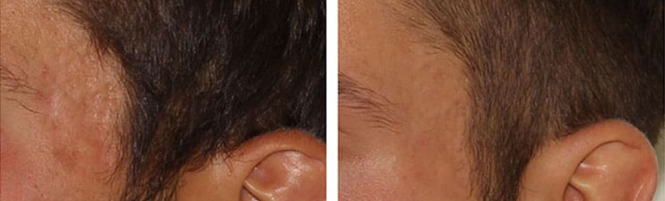 Acne Scarring Treatment – Patient Case #28 Combined Image