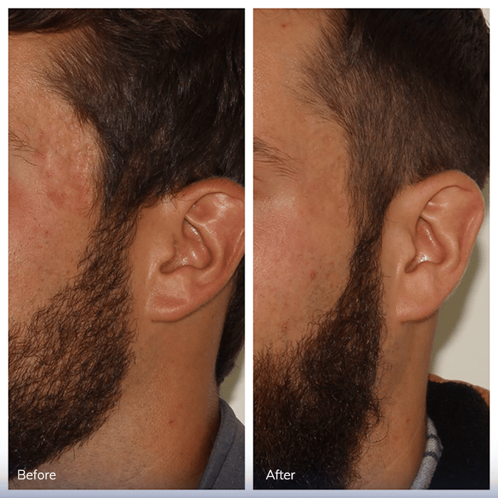 Acne Scarring Treatment – Patient Case #28 Combined Image