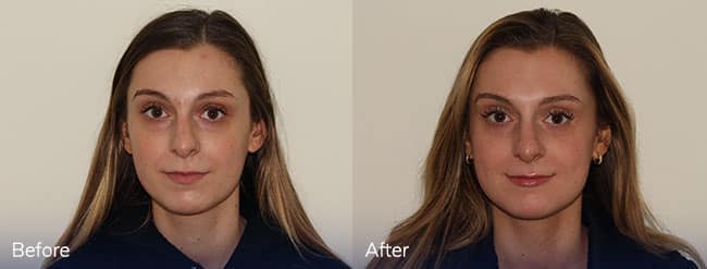 Medical Skincare + Vitalize Peel – Patient Case #23 Combined Image