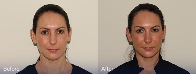 Dermal Filler Treatment – Patient Case #24 Combined Image