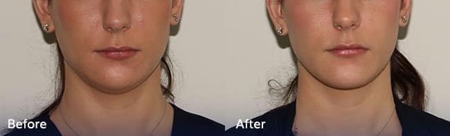 Juvederm Voluma – Patient Case #34 Combined Image