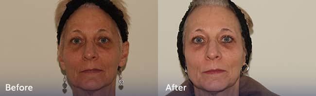 Phenol Peel Treatment – Patient Case 41 Combined Image