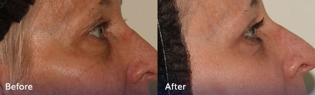 Phenol Peel Treatment – Patient Case 41 Combined Image