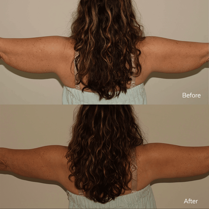 2 CoolSculpting Treatments – Patient Case #29 Combined Image