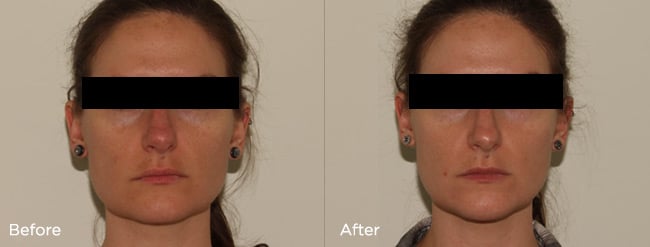 Medical Skincare + Vitalize Peel – Patient Case #26 Combined Image