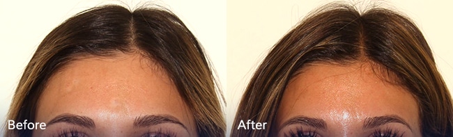 Silikon 1000 Injections – Patient Case #46 Combined Image