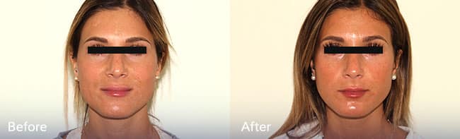 Silikon 1000 Injections – Patient Case #46 Combined Image