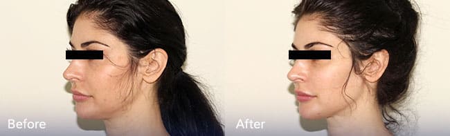 Jawline Contouring Treatment – Patient Case #50 Combined Image