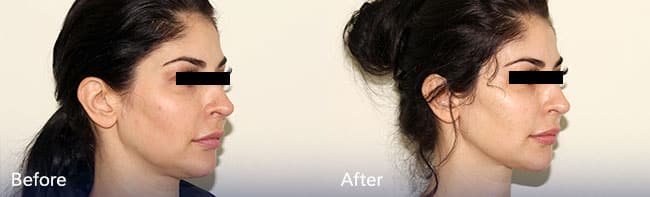Jawline Contouring Treatment – Patient Case #50 Combined Image
