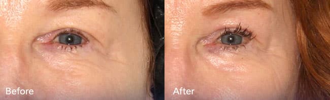 Silikon 1000 Injections – Patient Case #46 Combined Image