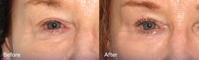 Phenol Peel Treatment – Patient Case #44 Combined Image