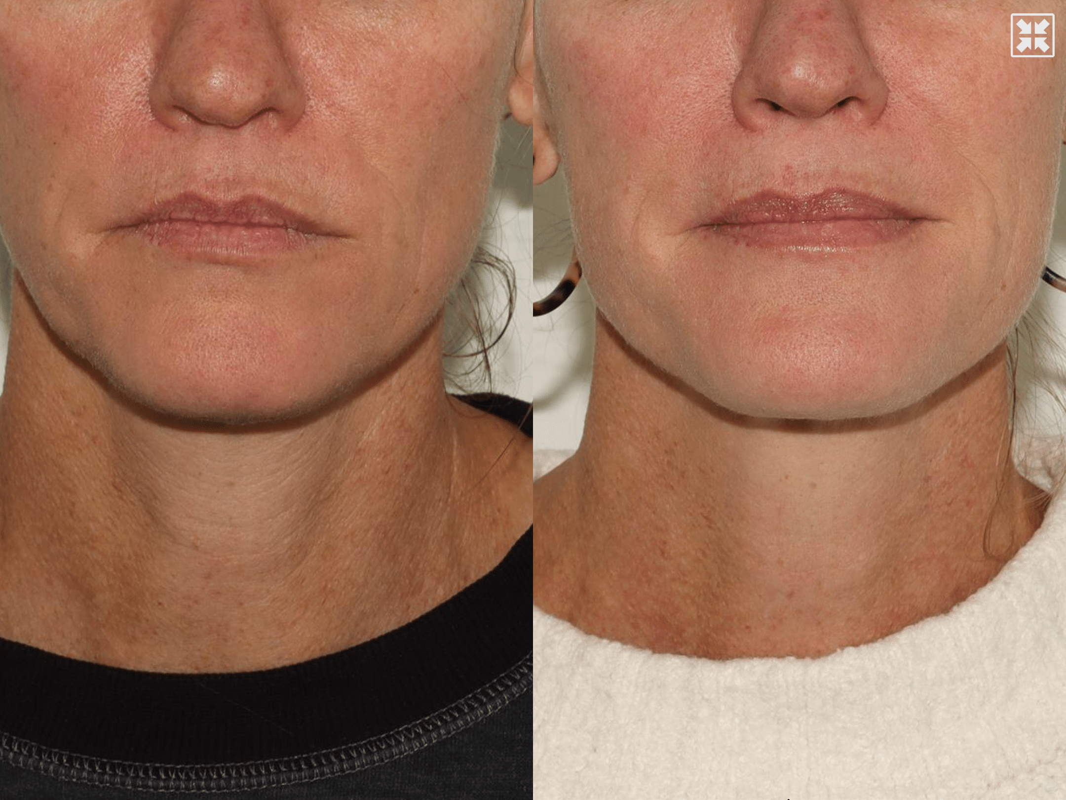 SKINVIVE by Juvederm – Patient Case #89 Combined Image