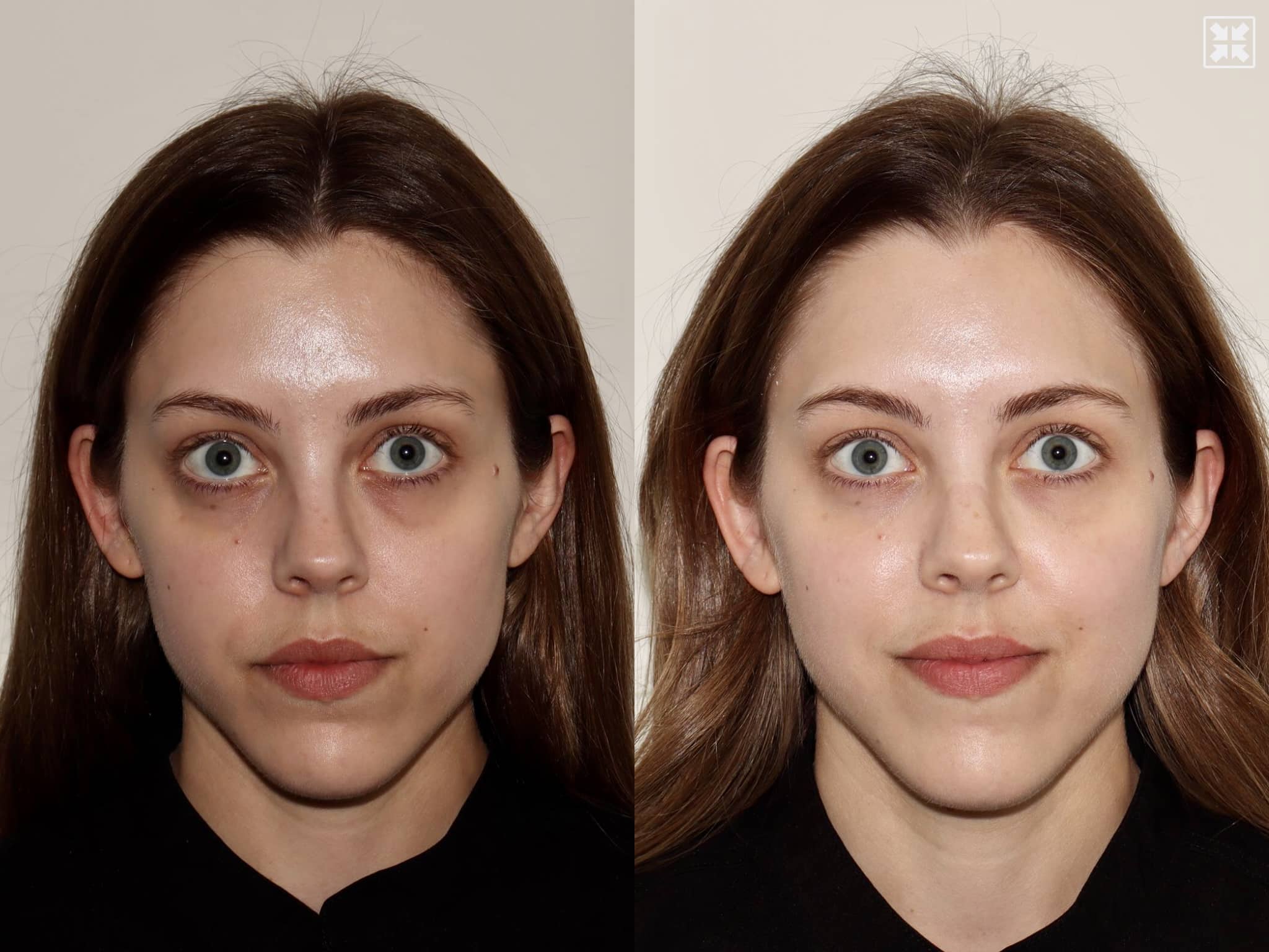 Juvederm Voluma + Juvederm Volbella – Patient Case #85 Combined Image