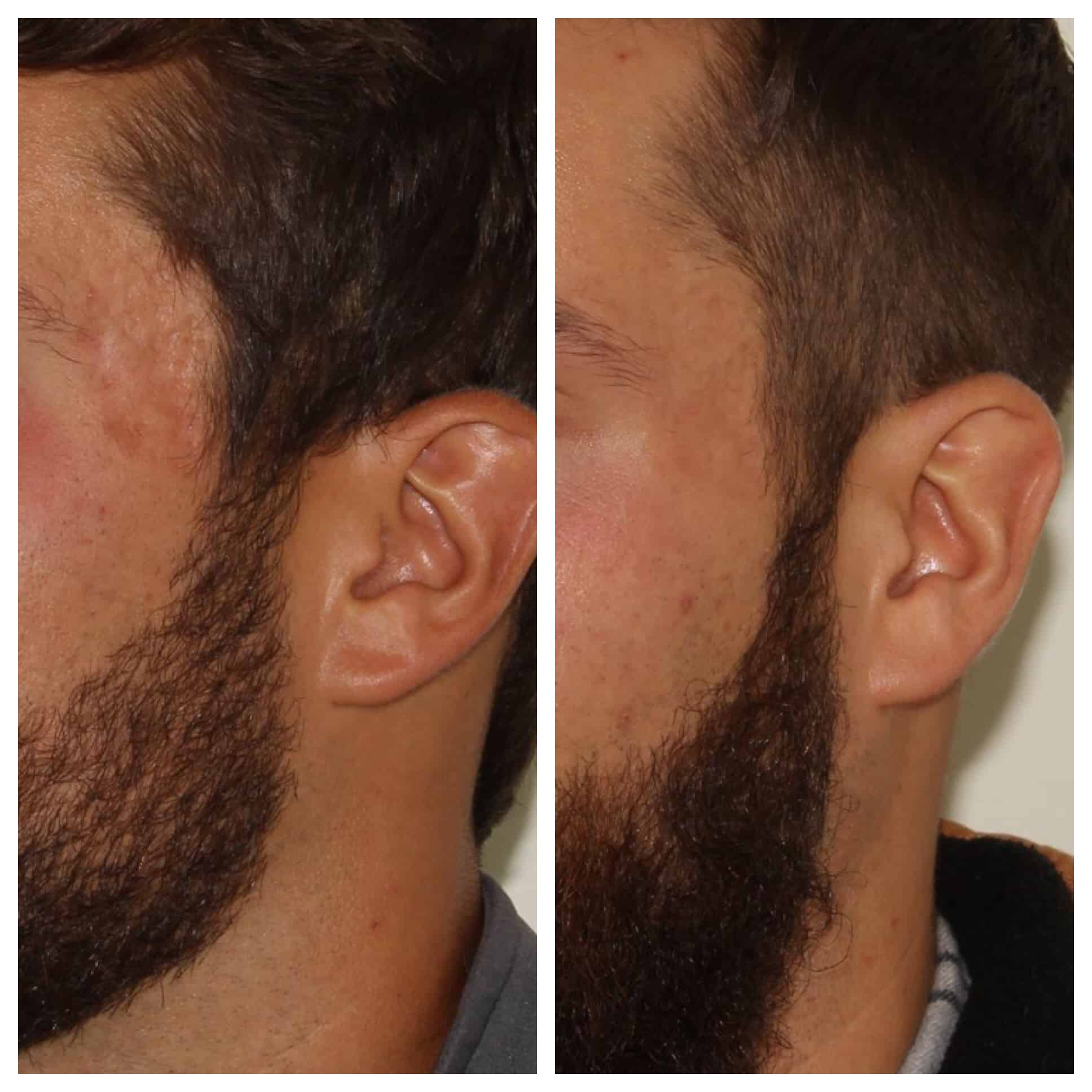 Acne Scarring Treatment – Patient Case #28 Combined Image