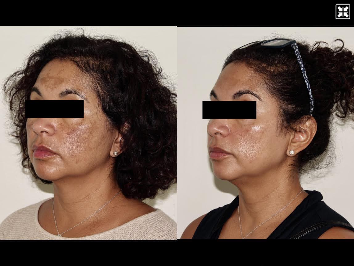 Medical skincare + Oral Medication – Patient Case #66 Combined Image