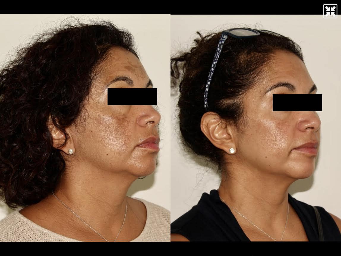 Medical skincare + Oral Medication – Patient Case #66 Combined Image