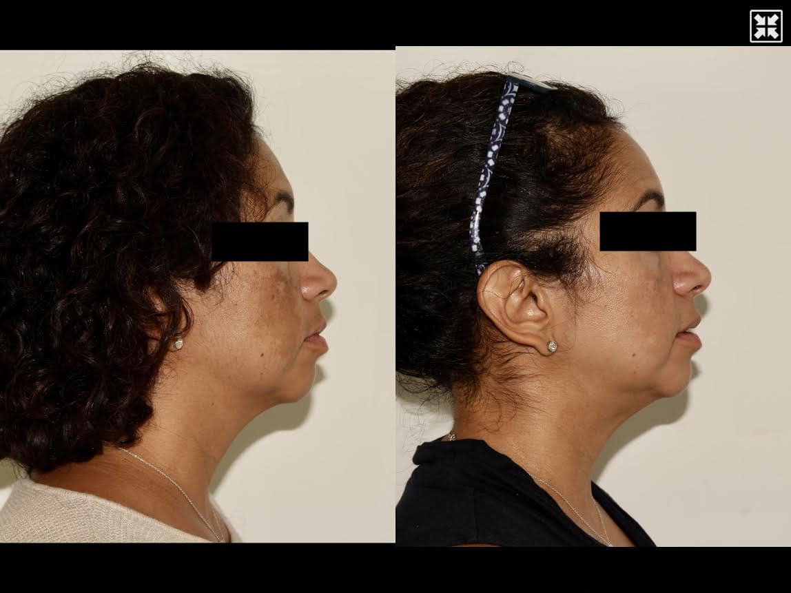 Medical skincare + Oral Medication – Patient Case #66 Combined Image