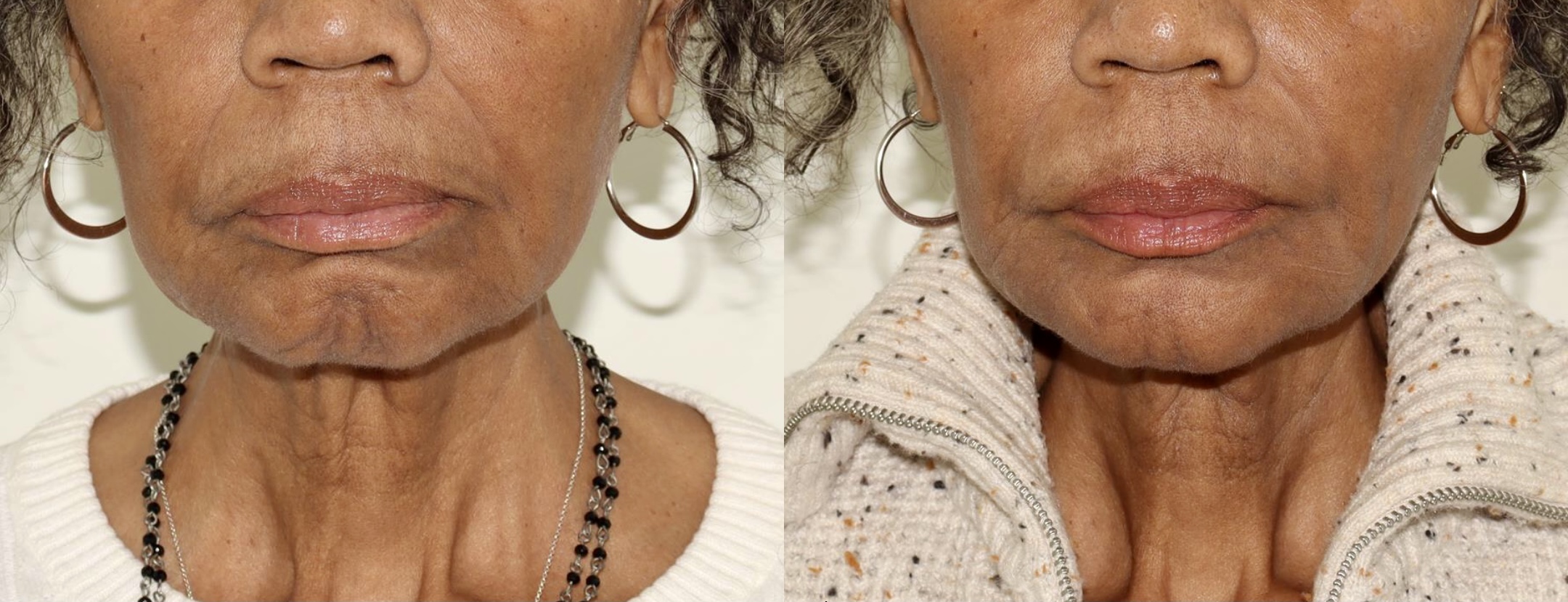 Botox + Juvederm Vollure – Patient Case #91 Combined Image