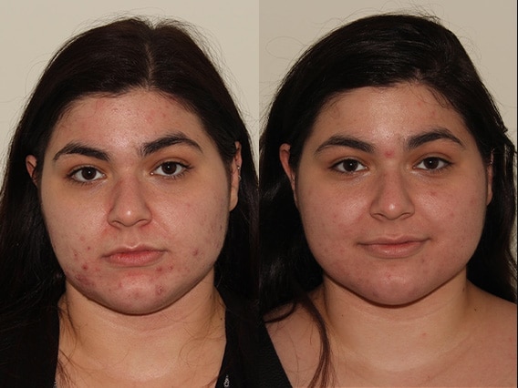 Medical Acne Treatment + BBL – Patient Case #45 Combined Image