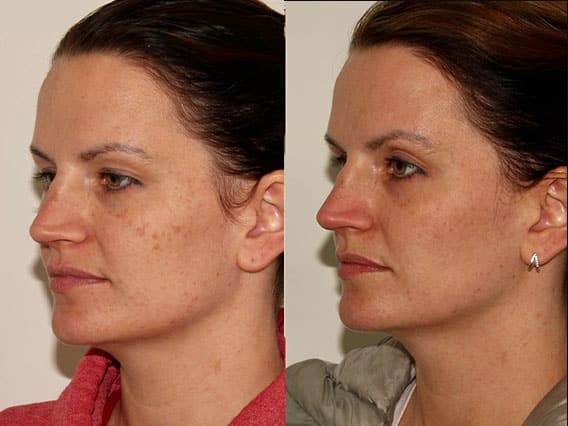 Laser Treatment – Patient Case #72 Combined Image