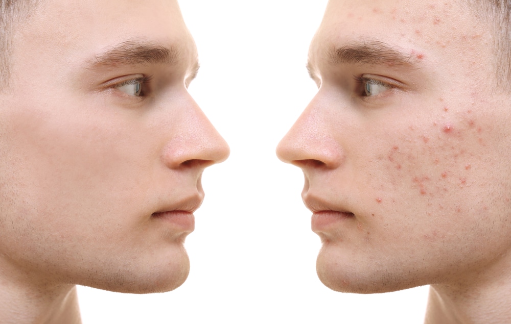 Removing Acne Scars and Restoring Your Confidence