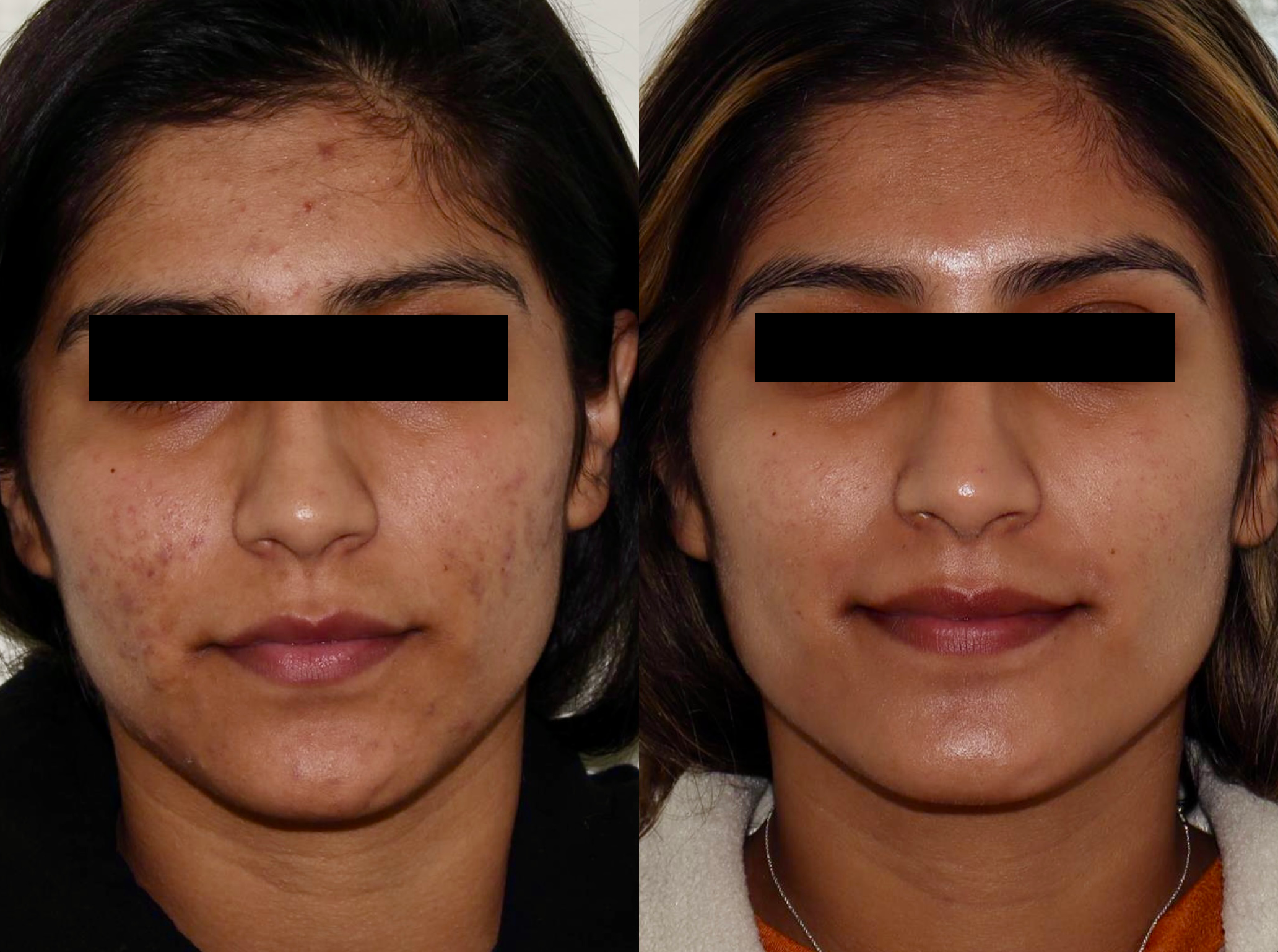 Acne & Rosacea – Patient Case #98 Combined Image