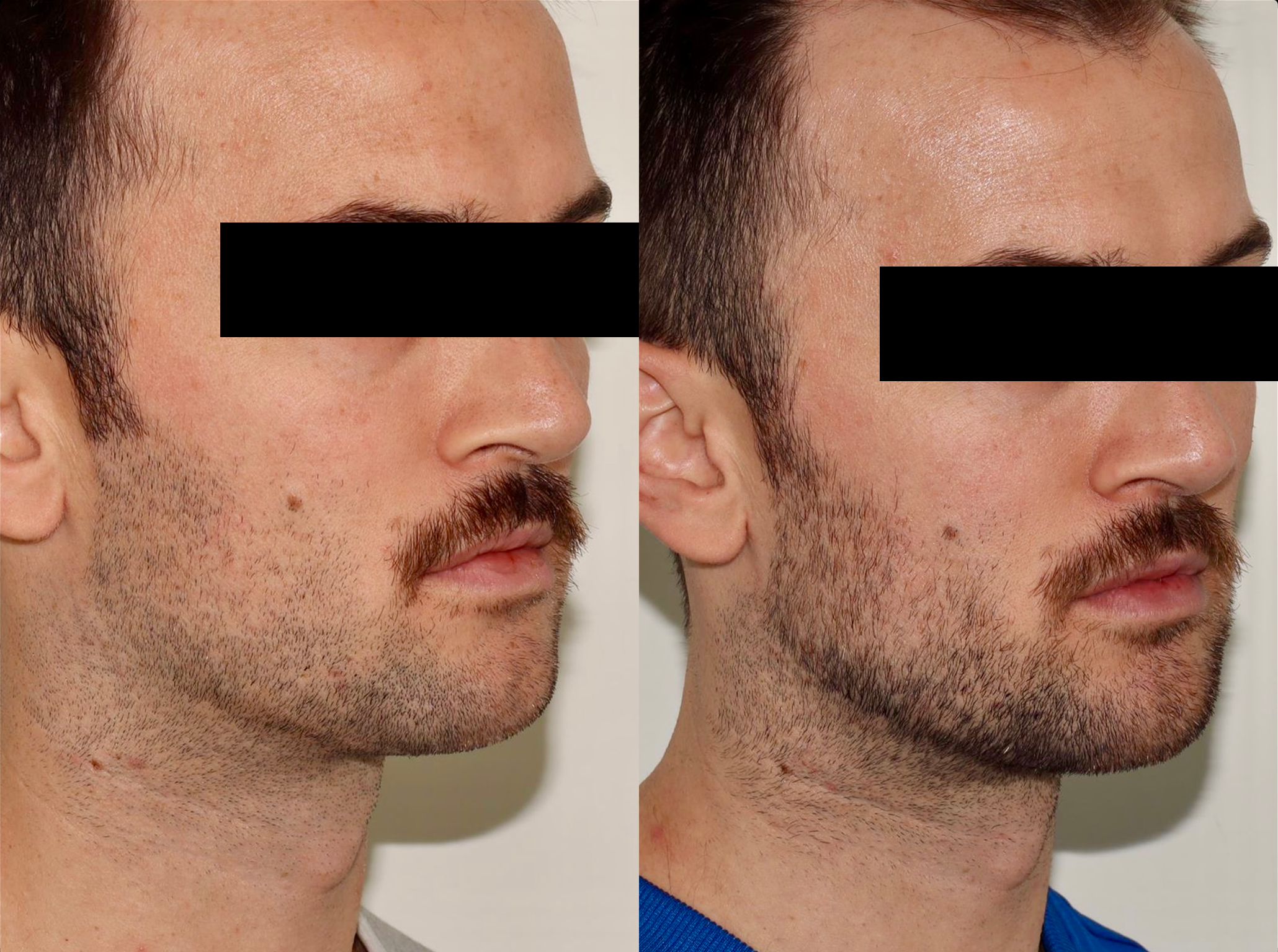 Dermal Fillers – Patient Case #97 Combined Image