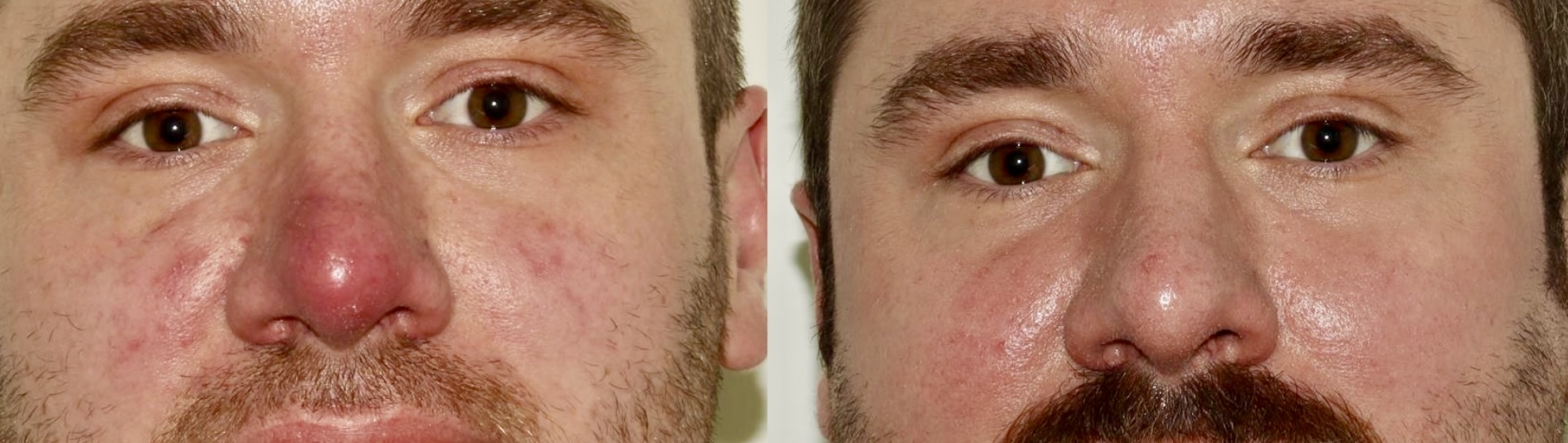 Acne & Rosacea / Laser Treatment – Patient Case #100 Combined Image