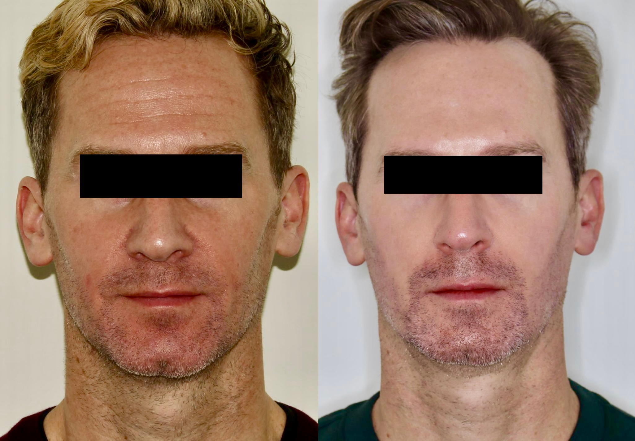 Botox + Filler + Alma Hybrid – Patient Case #111 Combined Image