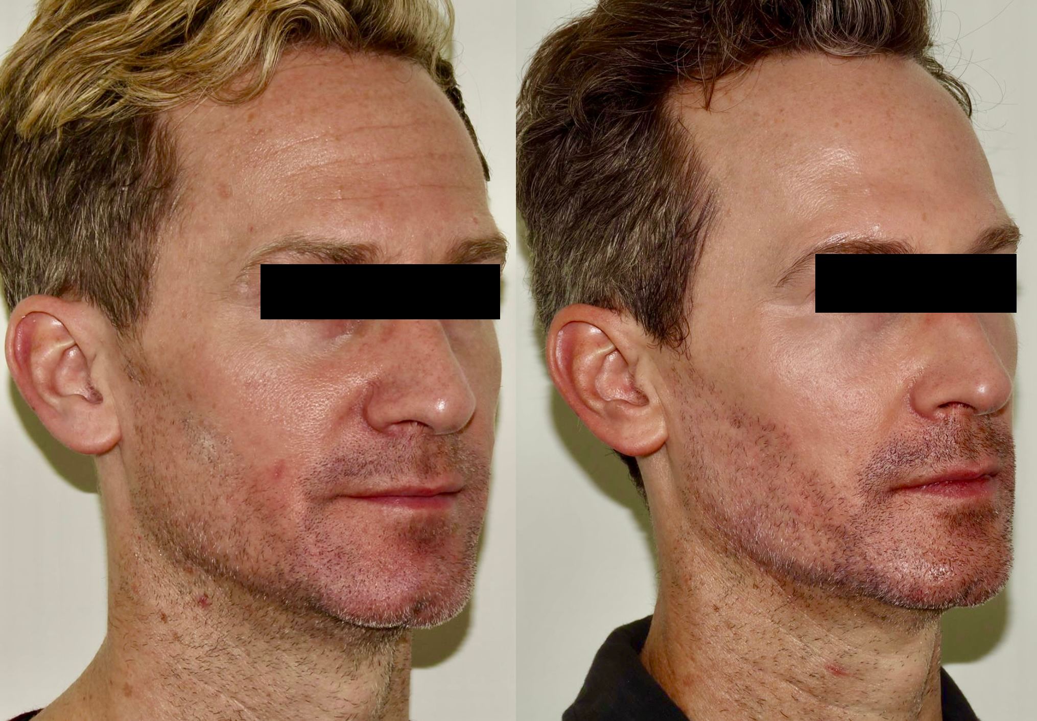 Dermal Fillers & Laser – Patient Case #106 Combined Image