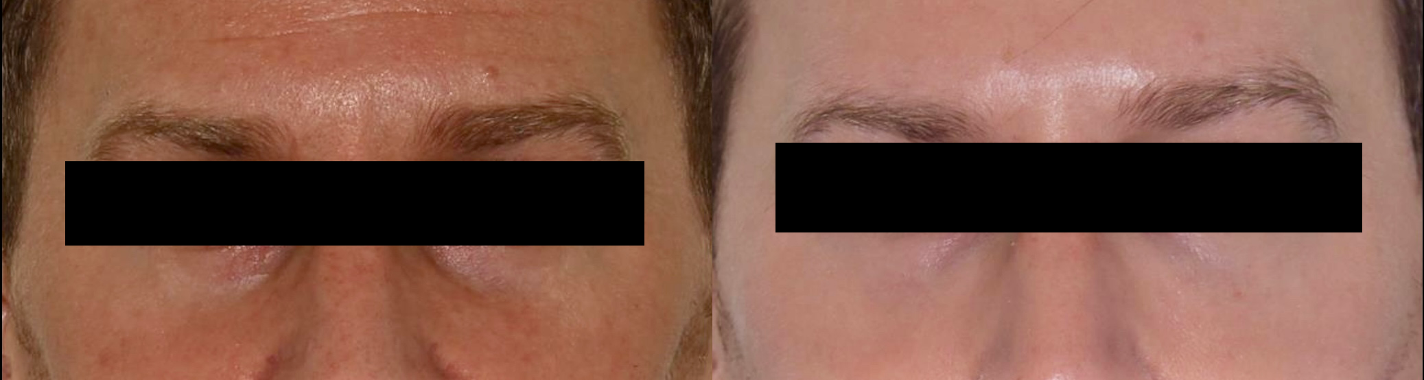 Dermal Fillers – Patient Case #105 Combined Image