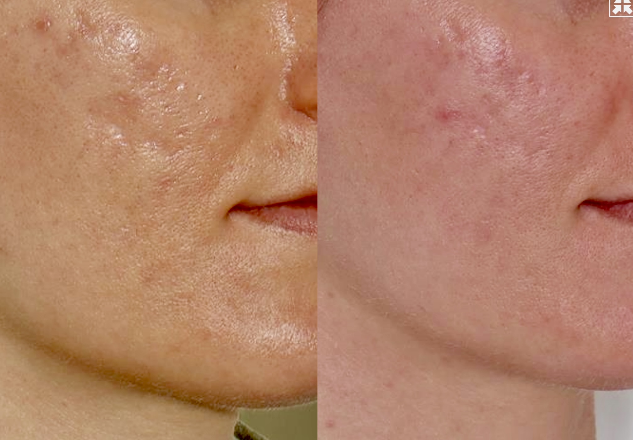 Acne Scarring – Patient Case #102 Combined Image