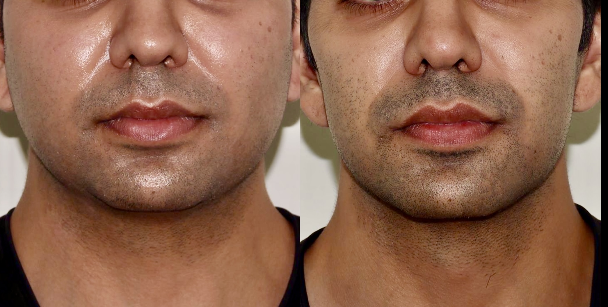 Sofwave + Botox + Dermal Fillers  – Patient Case #107 Combined Image