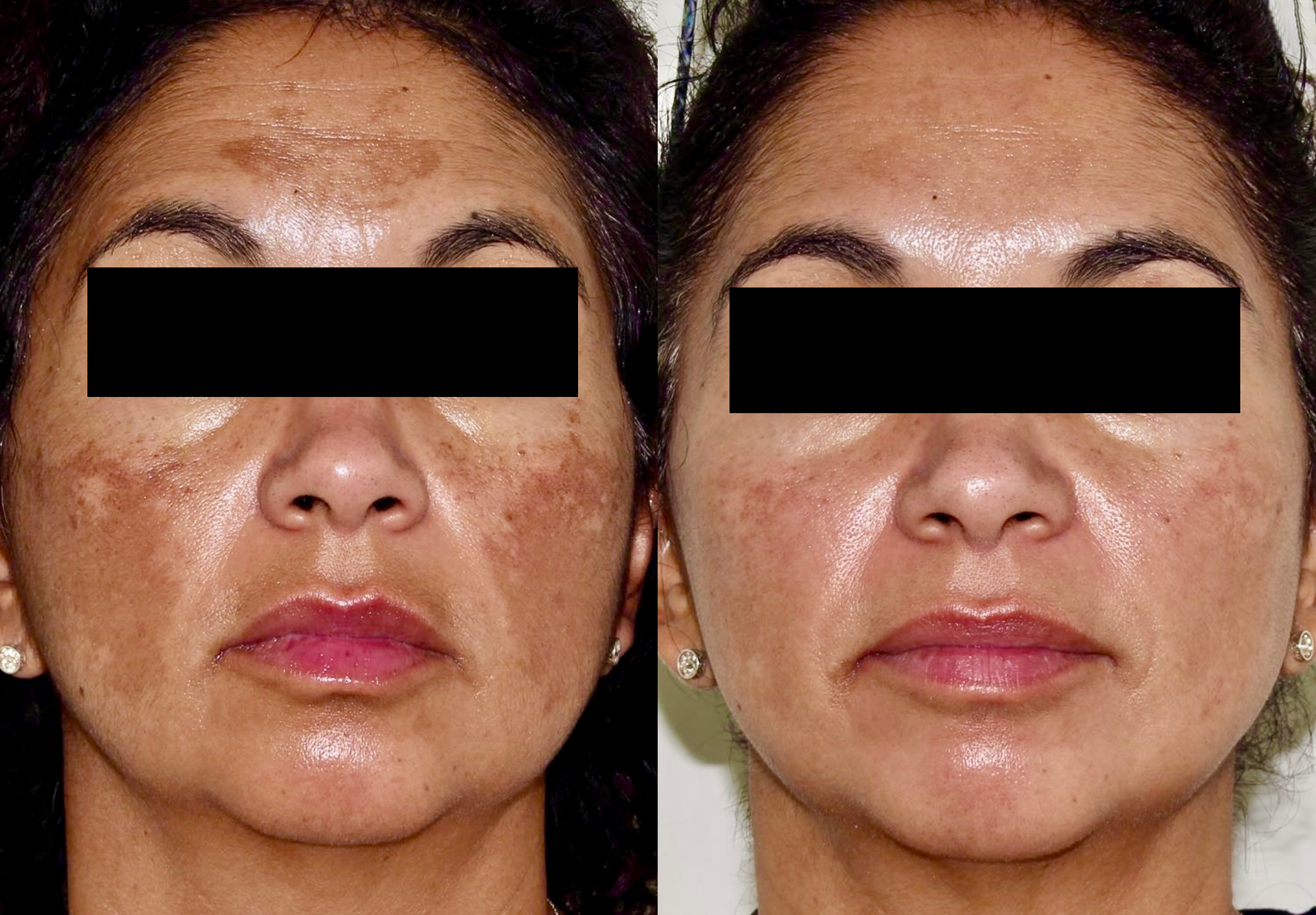 Skincare Treatment – Patient Case #110 Combined Image