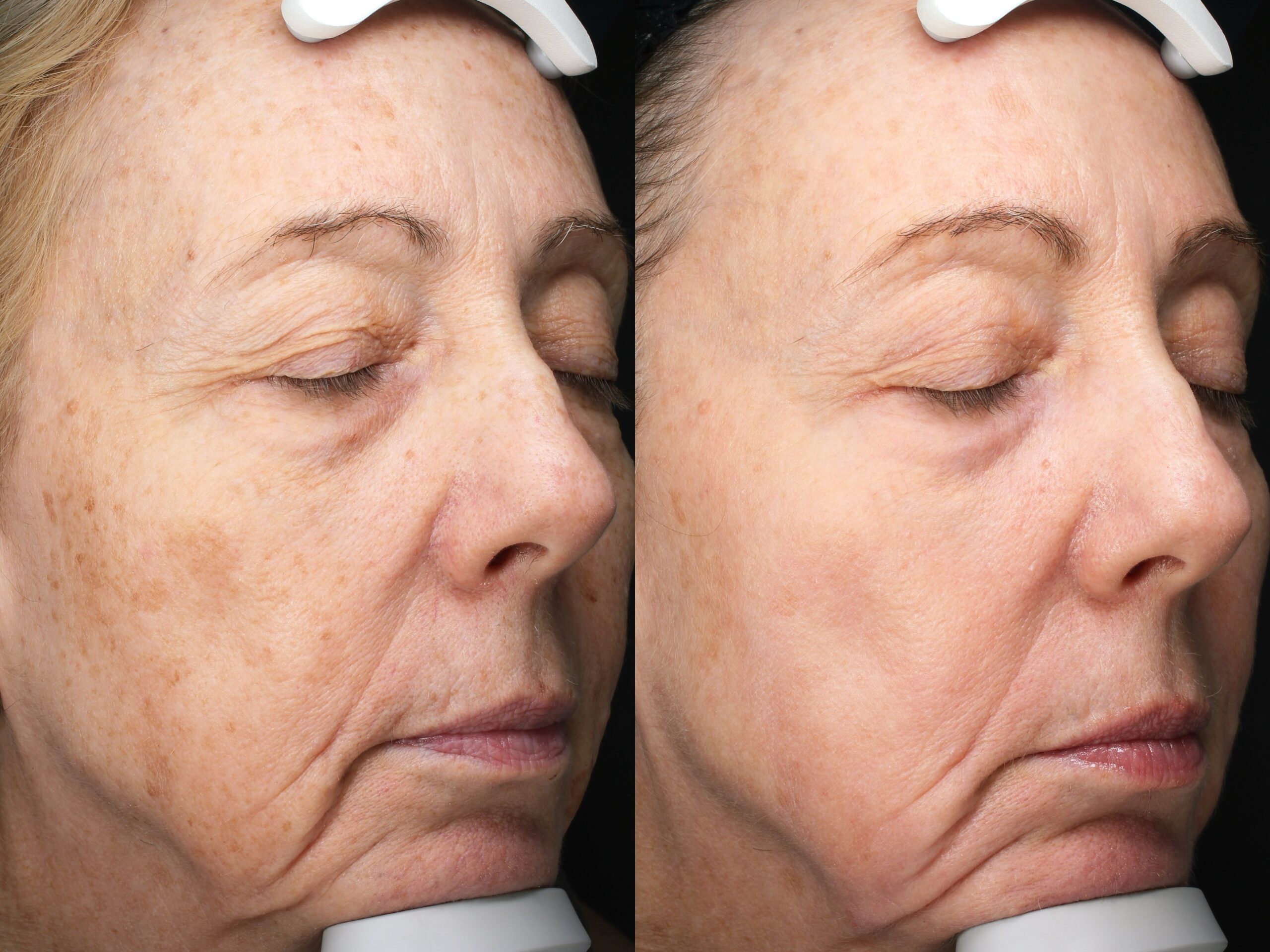 BBL + Alma Hybrid – Patient Case #109 Combined Image
