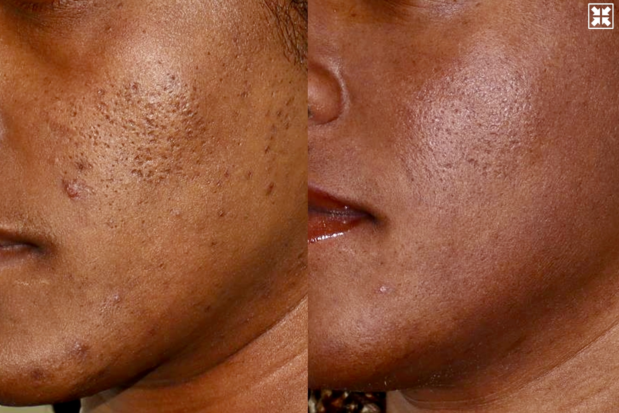 Acne Scarring – Patient Case #115 Combined Image